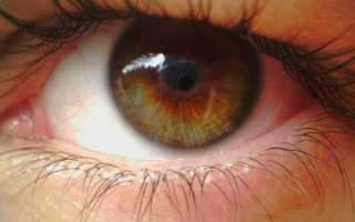 Симптомы и лечение ретиношизиса сетчатки глаза