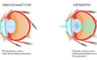 Что такое возрастная катаракта – как ее лечить