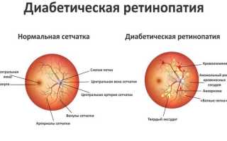 Что такое ретинопатия диабетическая?