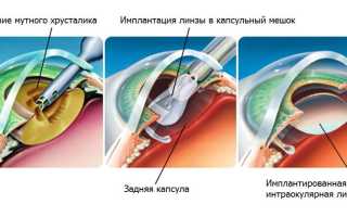 Реабилитация после удаления катаракты и замены хрусталика