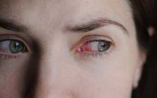 При какой болезни возникает боль в углу глаза у переносицы?