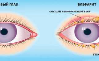 Что такое астенопия глаз и как ее лечить?