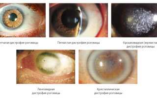 Симптомы и лечение дистрофии роговицы глаза