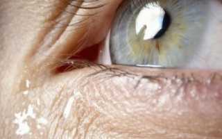 Проблема слезоточивости глаз – причины и лечение
