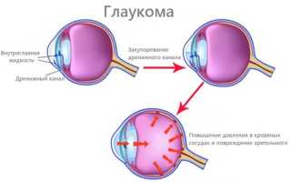 Лечение и особенности факолитической глаукомы