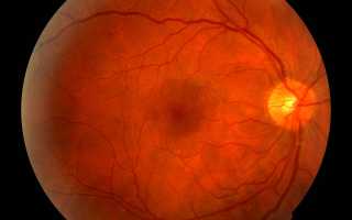 Что такое посттромботическая ретинопатия и как ее лечить