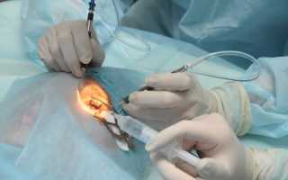 Хирургическое удаление катаракты: методы и проведение операции