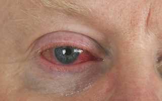 Что такое ожог сетчатки глаза?