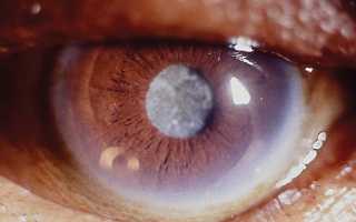 Что такая диабетическая катаракта — терапия и профилактика