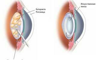 Проведение операции: факоэмульсификация катаракты
