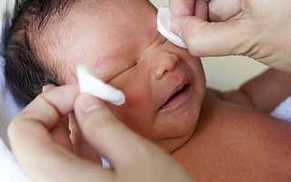 Как правильно делать массаж при дакриоцистите новорожденных