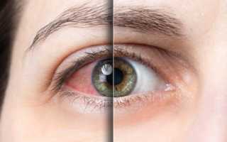 Почему возникает боль в правом или левом глазу и как ее лечить?