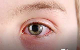 Что делать если у ребенка глаза красные и гноятся?