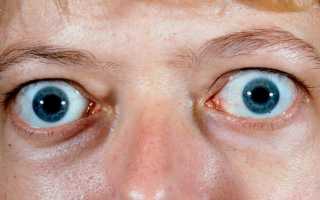 Что такое эндокринная офтальмопатия?
