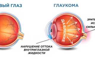 Как проявляются и чем отличается катаракта от глаукомы?
