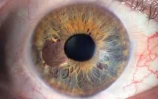 Как проявляется пигментная глаукома и ее лечение