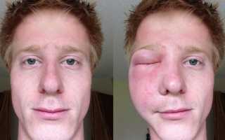 Как снять аллергический отек с глаз — советы врачей