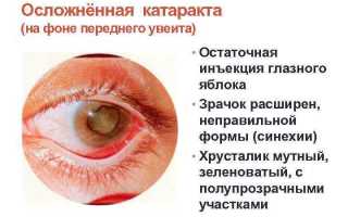 Осложненная форма катаракты: клиническая картина, развития и лечение